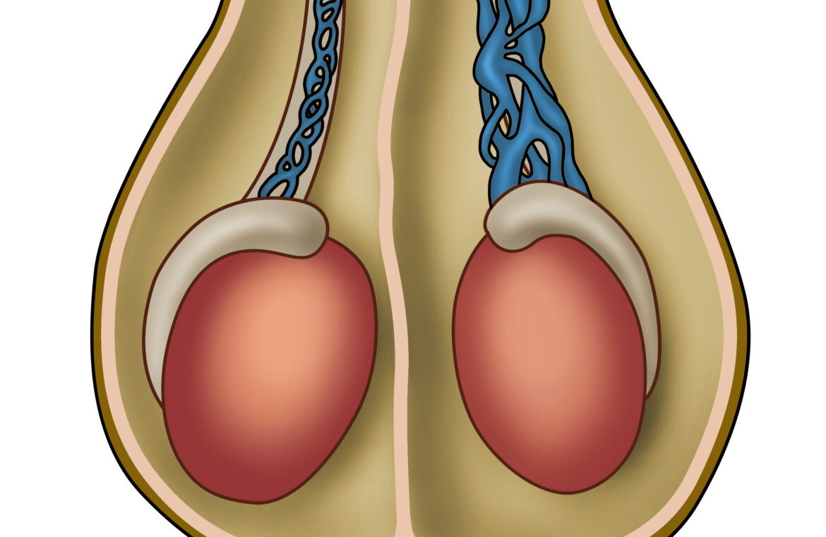 2 varicocele 1170x760