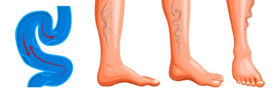 varicose veins